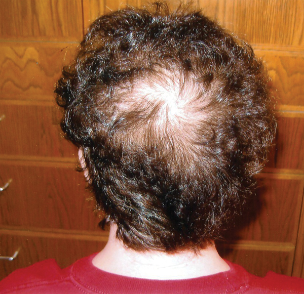Natural alternative to Rogaine, Regrow hair naturally